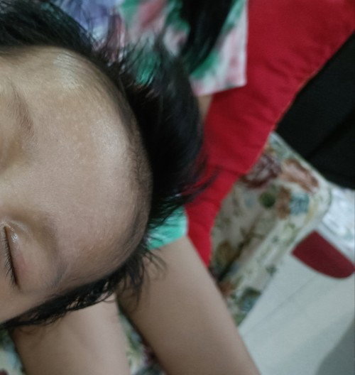 Puti puti sa forehead ni baby