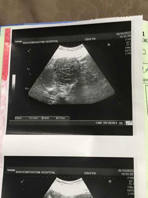 คุณแม่ท่านไหนเคยตรวจเจอ เนื้องอกระหว่างตั้งครรภ์มั้น น่ากลัวมั้ยแล้วจะอันตรายต่อเด็กมั้ย