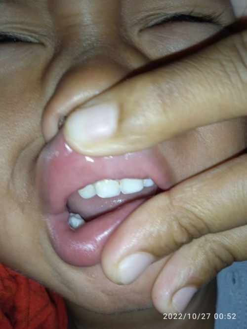 Gigi anak usia 2th gigis