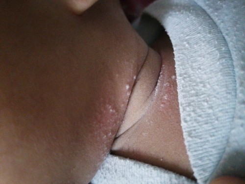 Ruam pada leher baby