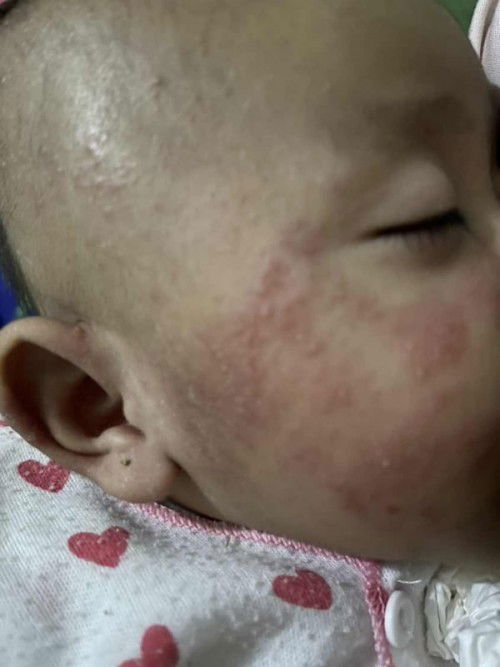 Gatal kasar merah pada bayi