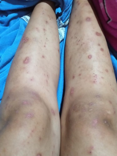 Assalamualaikum 
Mau tanya cara ngilangin gatal gatal gimana ya??