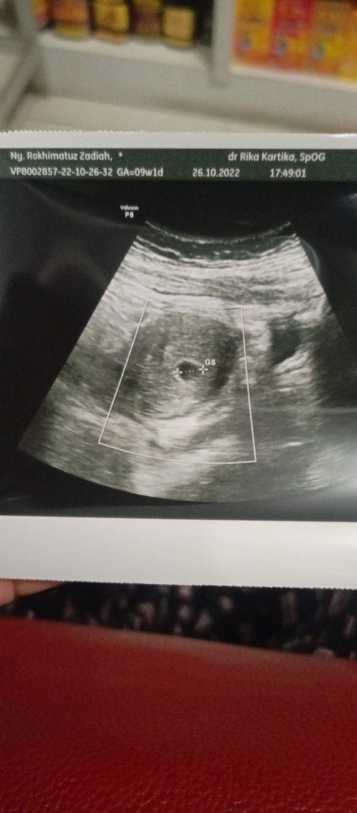 Ukuran kantong masih 1cm,hpht 9minggu wajar kah?