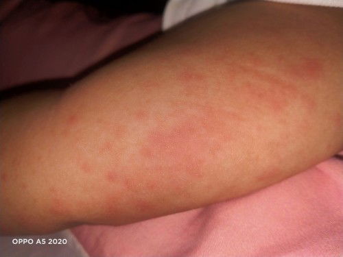 Mga momshie, bakit po kaya nagkakaganito ang balat ng baby ko?