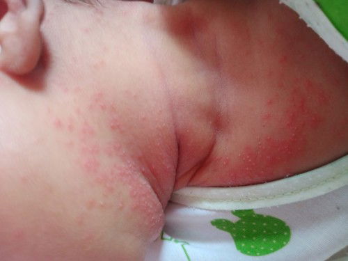 ผื่นที่คอทารก