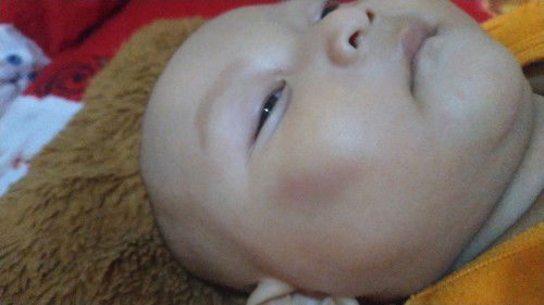 Bun mau nanyak ,bekas memar biru di wajah bisa hilang gak?