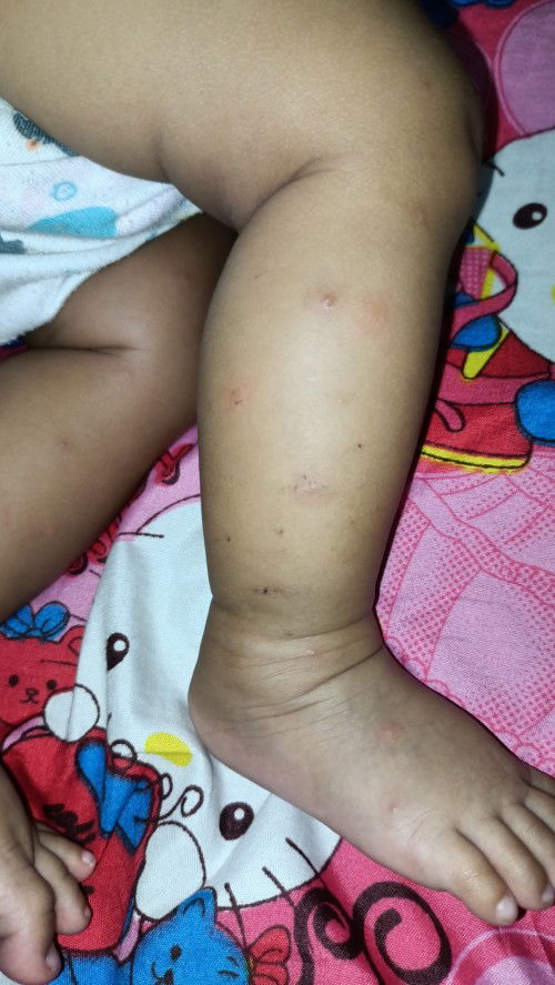Kaki Bayi 4 Bulan Gatal