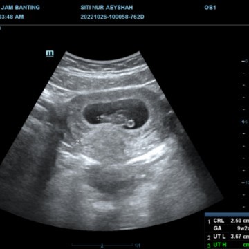 Fibroid , tapi tak kacau baby