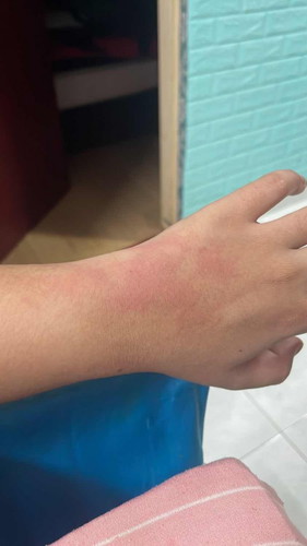 Ruam gatal secara tiba tiba satu badan hamil 35 minggu