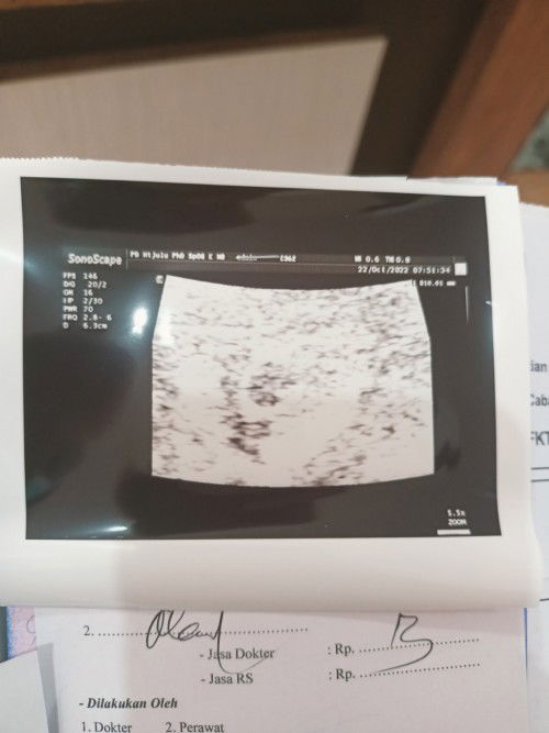 Bunda, bagi pengalamannya dong, hasil USG di 2 dokter  berbeda,hasilnya juga berbeda