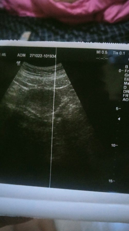 Penebalan dinding rahim