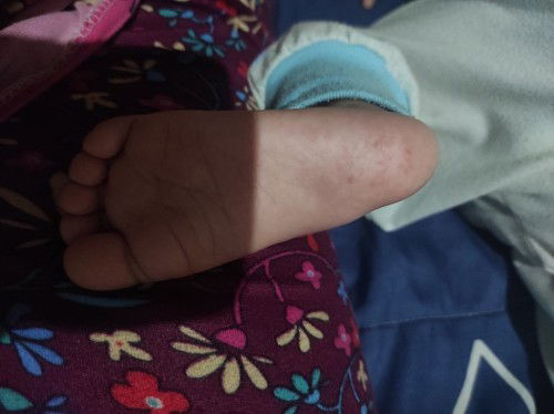 Redness sa paa ni baby