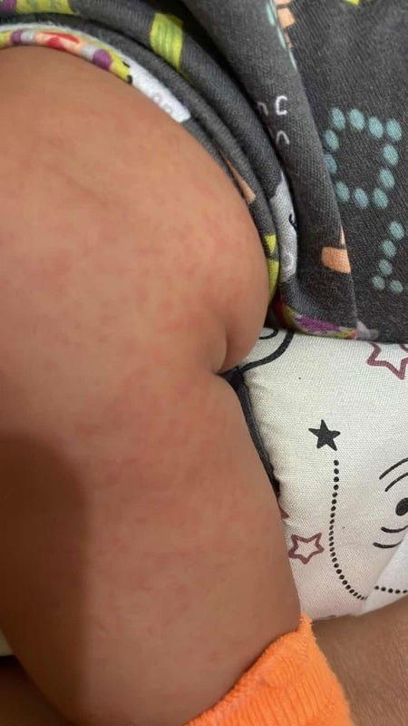 Bintik-bintik merah di kulit bayi