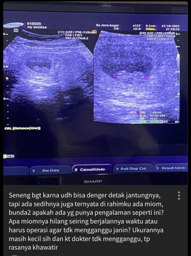 Apa ada disini mom yg pengalaman hamil dan ada miom sekaligus?