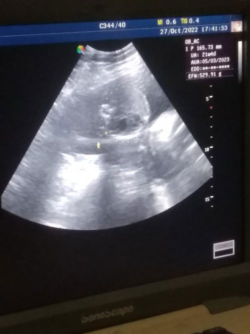 hamil 21 minggu normal ngak ya kalo janin masih segitu