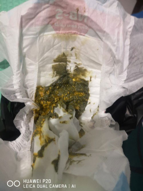 kalo feses bayi warna keabu2n kaya semen,kdng kehijauan pke sufor morinaga (usia 2 bulan) knpa ya bu