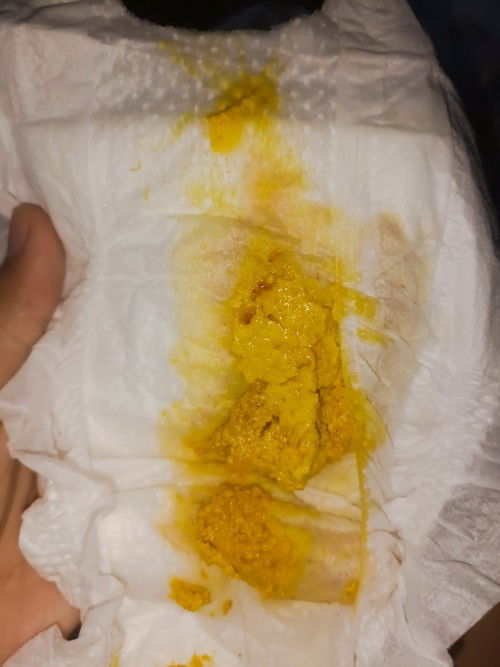 ทารกอายุ7วันถ่ายแล้วมีมูกปน มันปกติมั้ยคะ