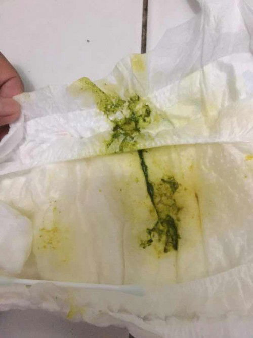 สีอึลูกแบบนี้ปกติไหม