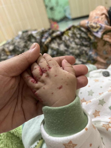 Hemangioma