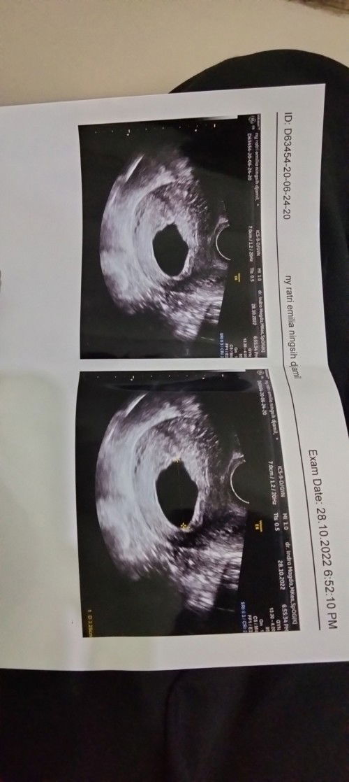 AKHIRNYA NYERAH JUGA DENGAN SENDIRINYA,
HAMIL UK 10W HARUS KURETASE KARENA BO (HAMIL KOSONG0