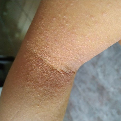 Gatal gatal setelah Caesar..