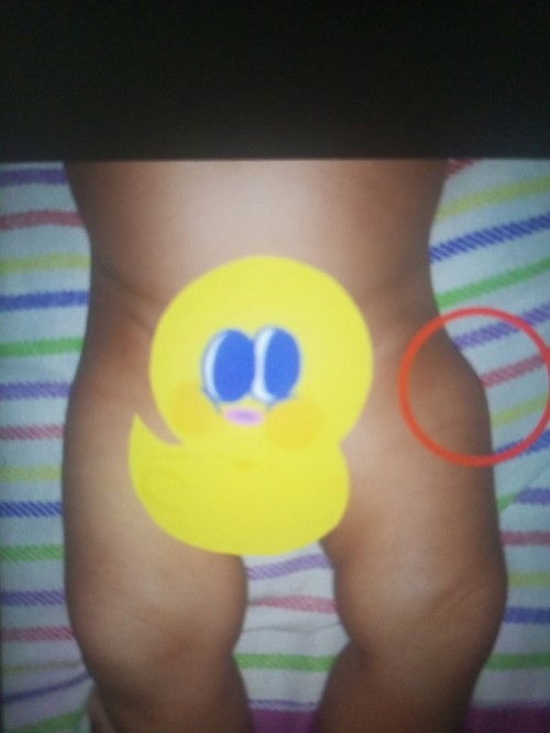 Benjolan di paha pasca imunisasi