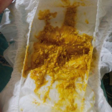 น้องกินนมผงถ่ายเเบบนี้ปกติมั้ยคะต้องทำยังไงคะ