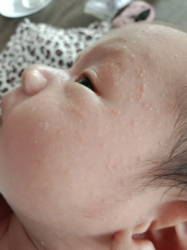 น้องมีผื่นขึ้น