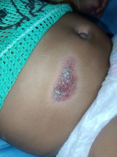 ลูกน้อยเป็นแผลถลอก