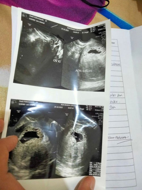 Janin tidak berkembang