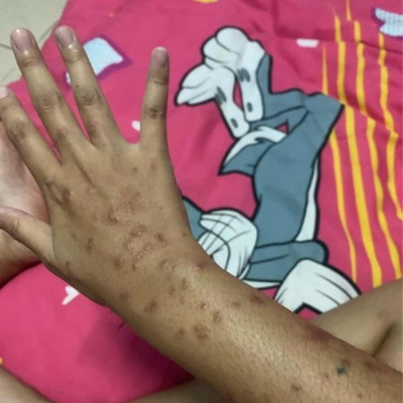 ถามแม่ๆค่ะคันคนท้อง