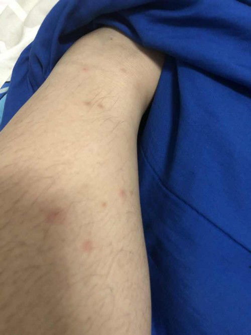 เป็นตุ่มตอนตั้งครรภ์