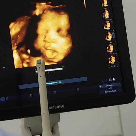 น้องได้31w6d ลูกสาว