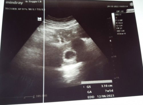 Hasil USG 7w 5d