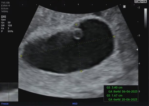 ตั้งครรภ์8wนับจากประจำเดือนล่าสุด ยังไม่เจอตัวอ่อนเจอแต่ถุงไข่แดง หมอบอกว่าท้องลม100%