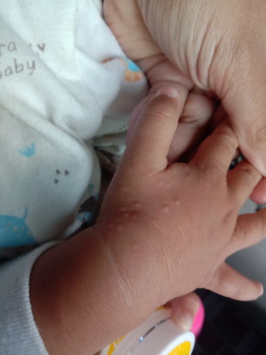 Tangan bayi saya bintik bintik begini , ada yg tau ini biang keringat atau apa yaa