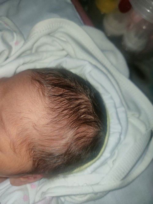 Visible coronal suture (bone line sa skull)