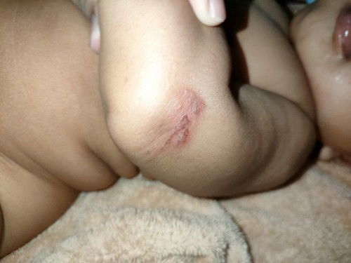 kulit merah seperti melepuh