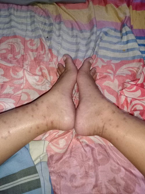 Awal nya makan apa aja gak ada pantangan , 1 Minggu yg lalu makan ikan pindang terus makan telur