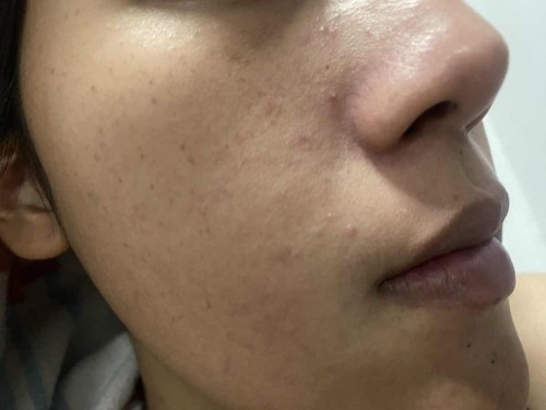 แพ้ สิวเห่อเยอะมาก