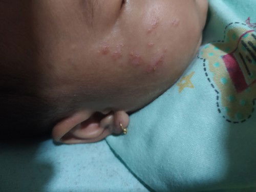 Ruam di pipi