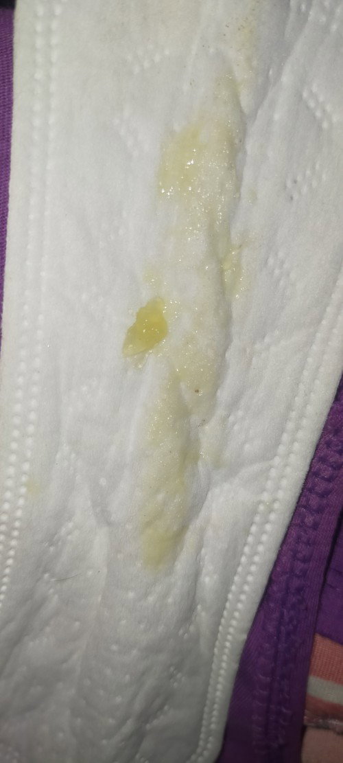 ito po ba yung tinatawag nilang mucos plug.?