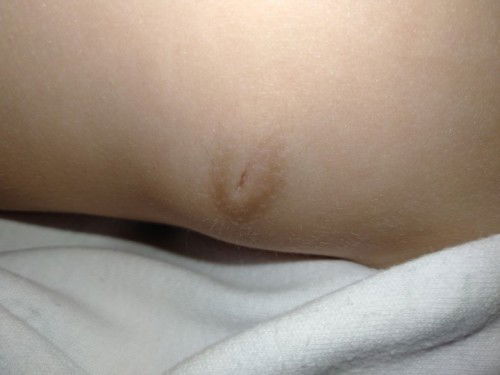 Bukol sa dede ni baby 1yr old and 1 month