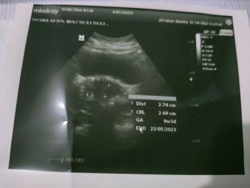 Apakah Saya beneran Positif Hamil dengan Siklus Haid yang tidak Pernah Lancar dan Sangat Jarang Haid