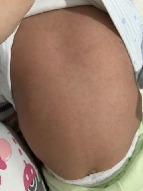 Muncul merah merah setelah demam