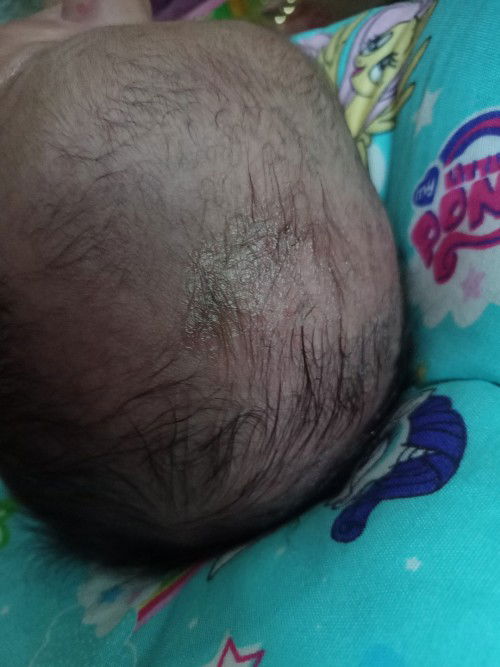 Rambut rontok pada bayi