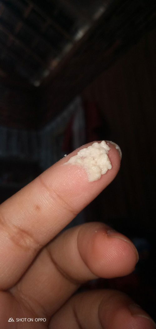 Keputihan menggumpal seperti susu apakah normal saat hamil Bun?