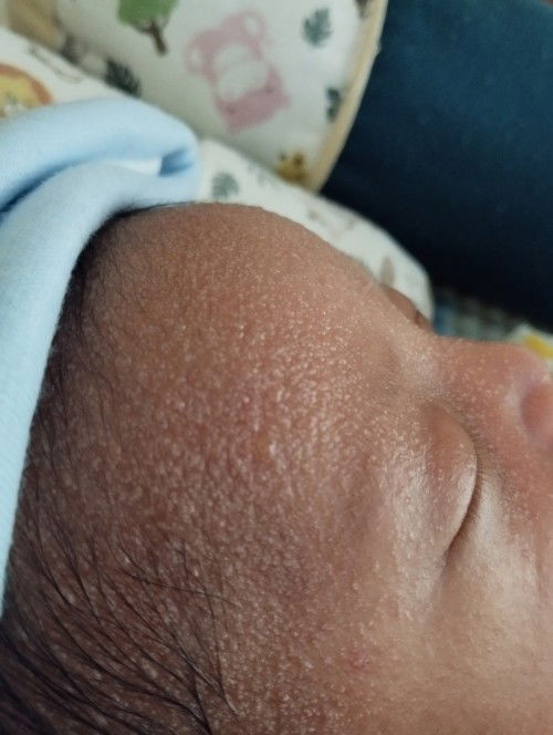 Biang keringat pda baby