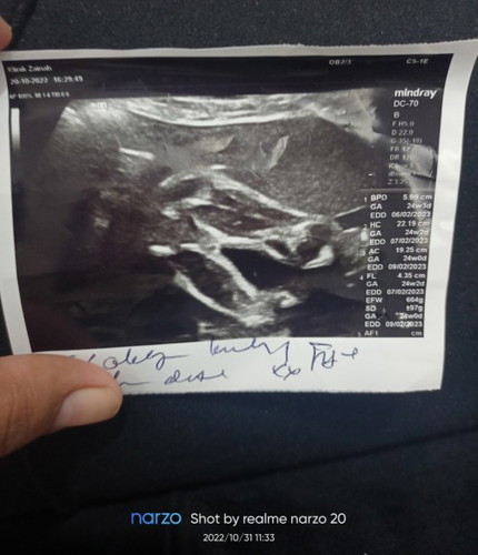 Boy @girl... Scan doc 24w... Bby malu² nak tjuk gender