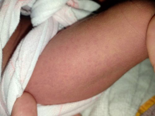 Rôm sẩy tắm gì